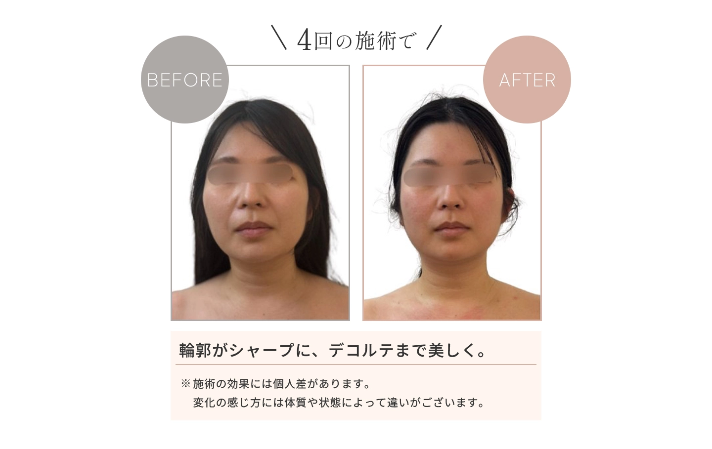 4回の施術で